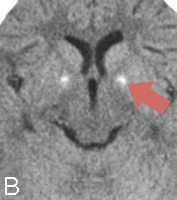 MRI-CoPANb-4
