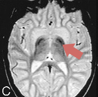 MRI-CoPANc-4