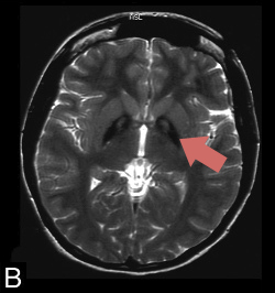 MRI-PKANbv2-3
