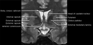 MRI Findings | NBIA